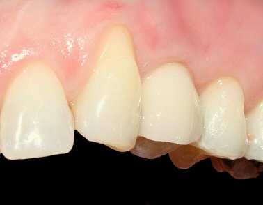 Zubní implantát a keramika 2
